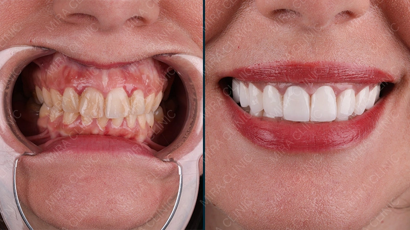 Hollywood smile Istanbul Before After